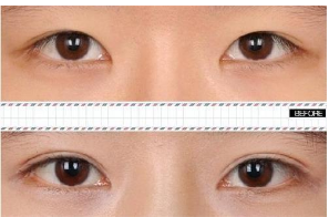 双眼皮