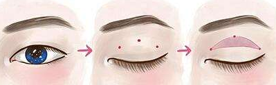 三点式双眼皮.png