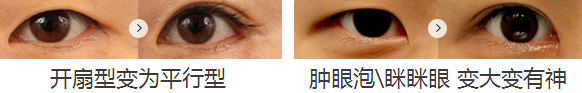 双眼皮
