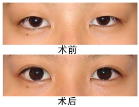 双眼皮