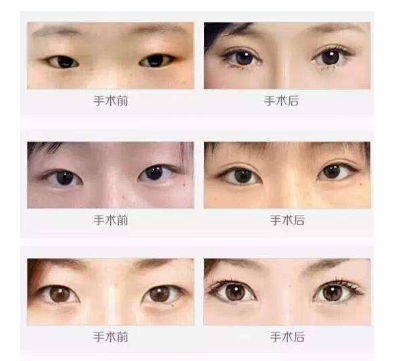 割双眼皮后可以变大眼吗?