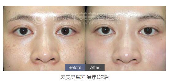 南京做激光祛斑会留疤吗?