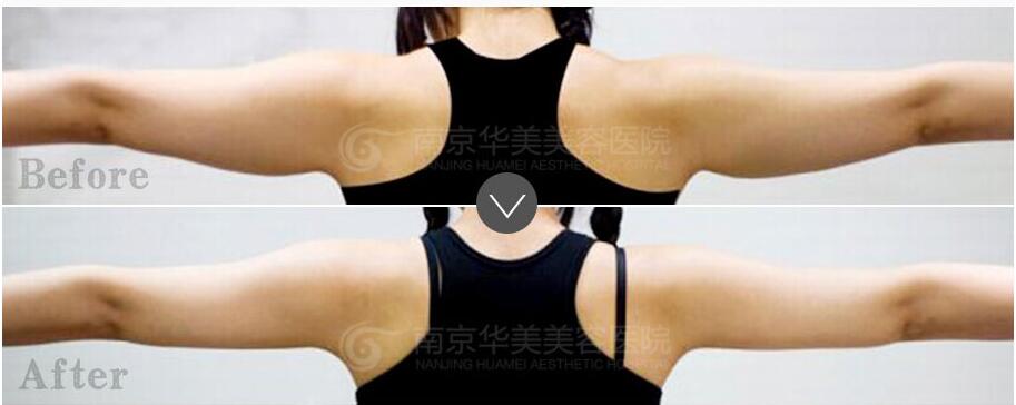 南京快速瘦胳膊的方法?