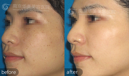 南京面部的斑点如何祛除