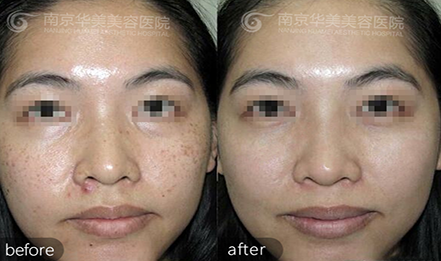 南京激光祛斑角质层容易变薄吗